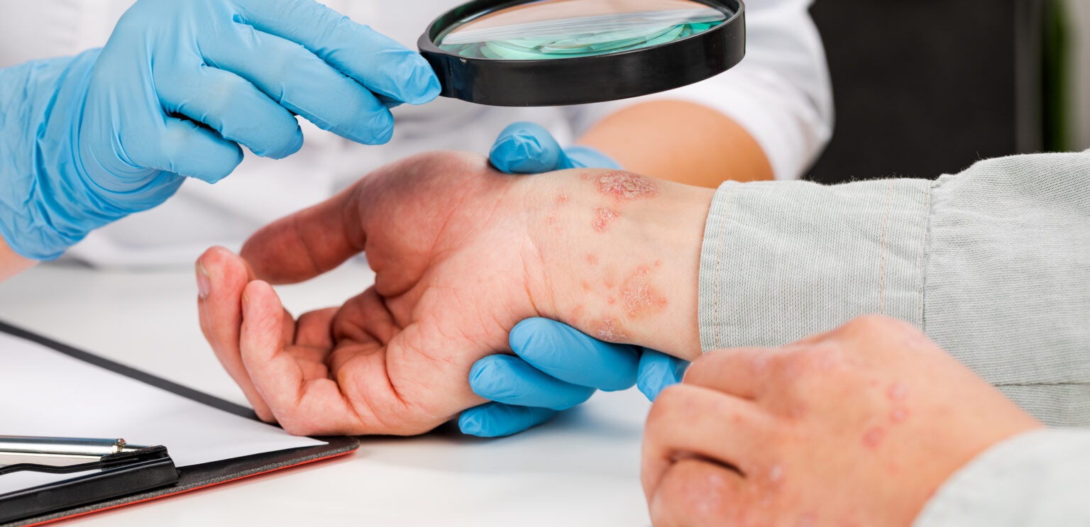 dermatologist wearing gloves examines skin sick patient examination diagnosis skin diseasesallergies psoriasis eczema dermatitis 2 LIV Hospital