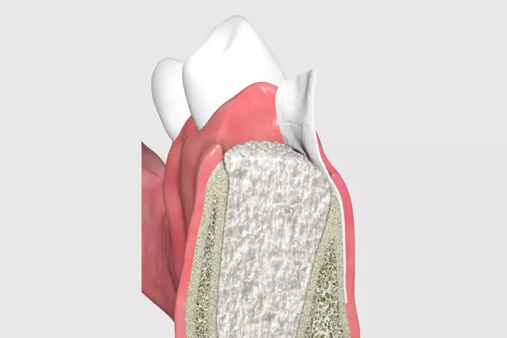 What Does Graft Mean? Definition and Examples Explained 2 What Does Graft Mean? Definition and Examples Explained