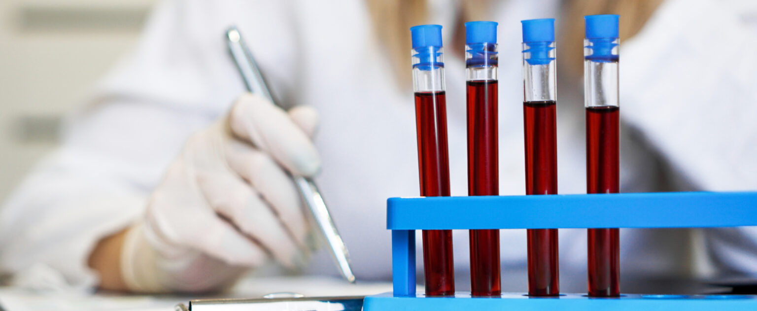 woman working with blood samples laboratory closeup doctor writes test results 1 LIV Hospital