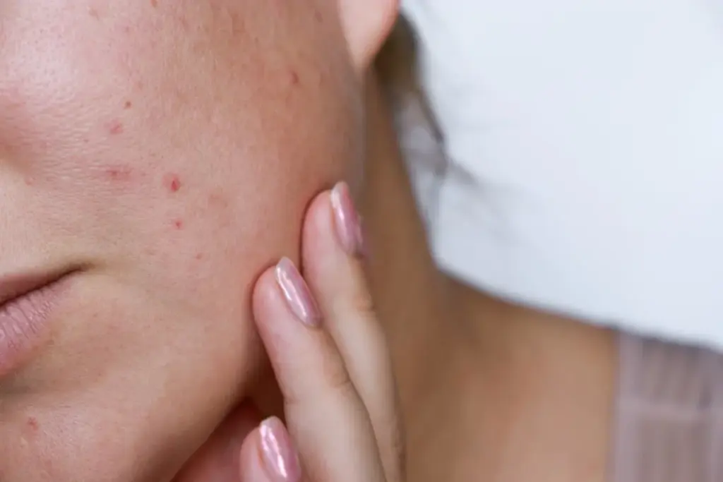 How to Get Rid of Deep Pimple Scars: 5 Proven Treatments