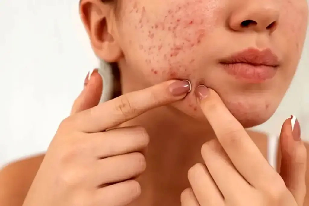 How to Get Rid of Pimple Scars: Complete Guide