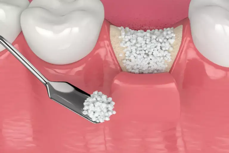 How to Get a Gum Graft: Complete Surgical Guide