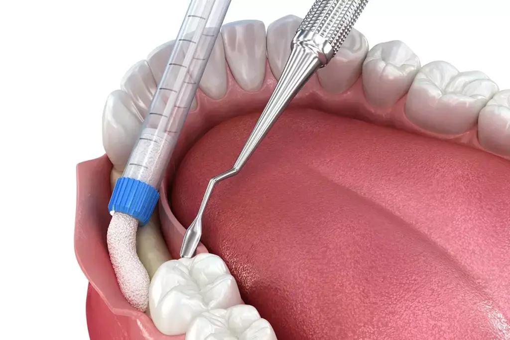 How to Get a Gum Graft: Complete Surgical Guide