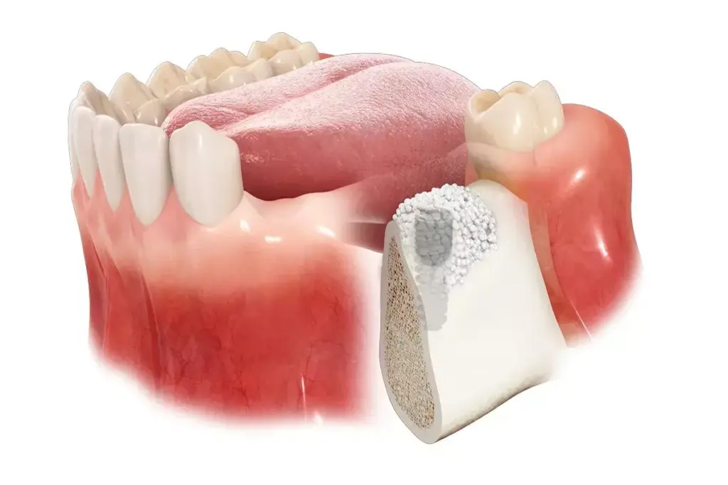 How to Get a Gum Graft: Complete Surgical Guide