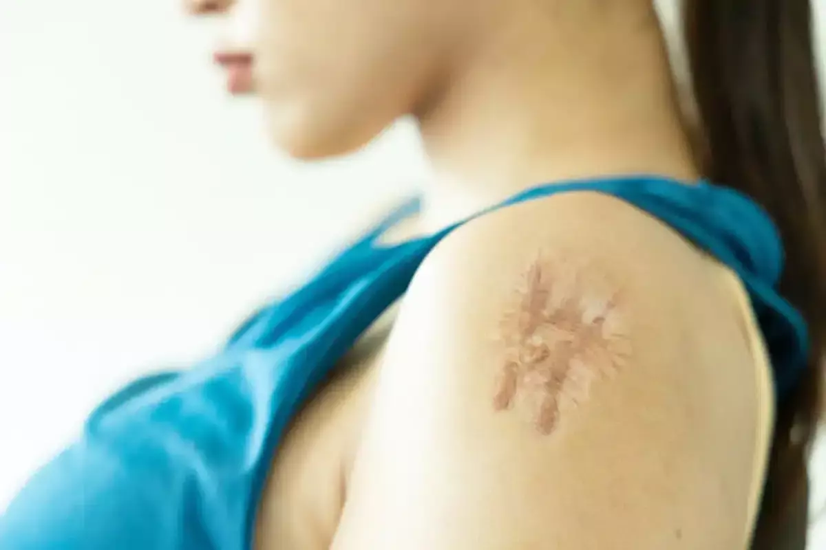 Will Hypertrophic Scars Go Away? Understanding Scar Healing Stages