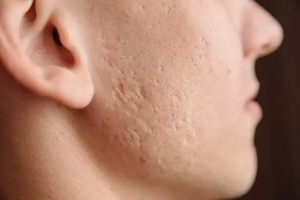 Does Scar Gel Work on Old Scars? What the Science Says