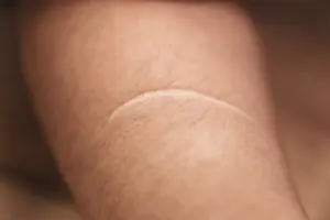 Does Scar Gel Work on Old Scars? What the Science Says