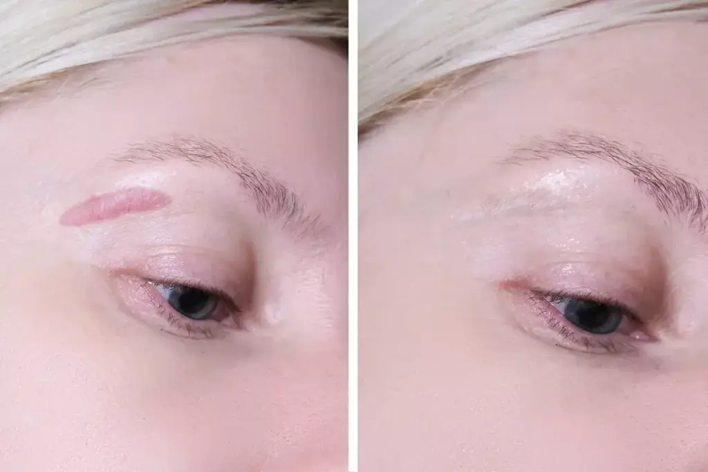 Does Scar Gel Work on Old Scars? What the Science Says