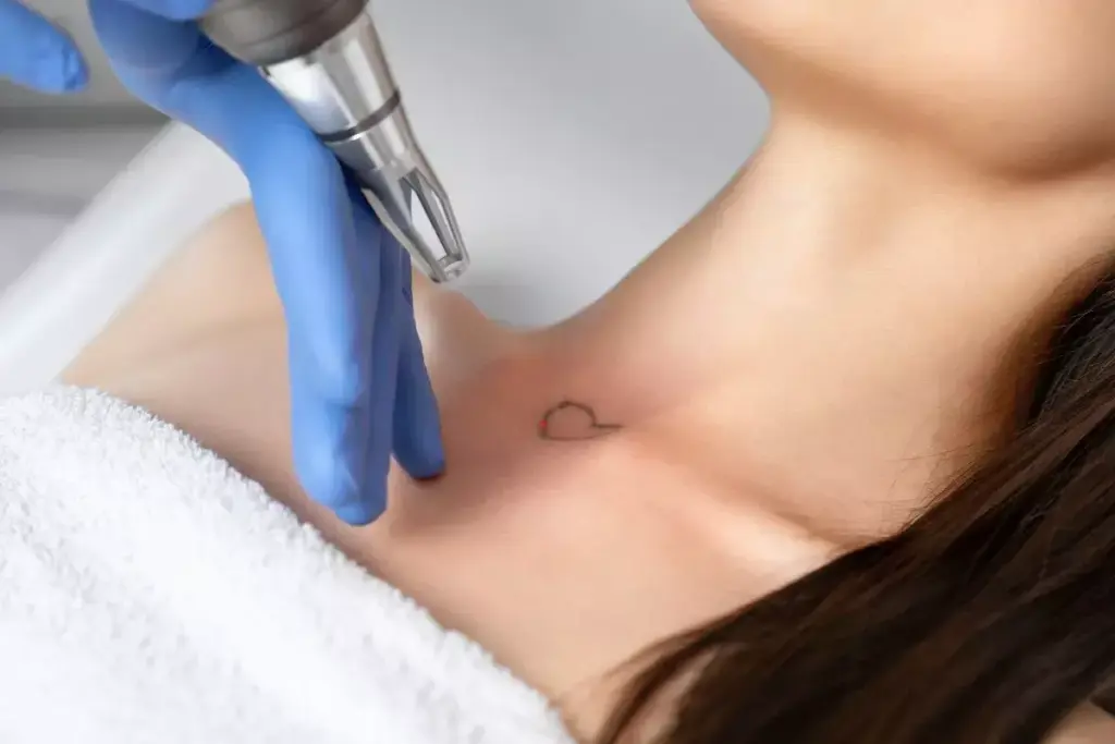 Does Laser Tattoo Removal Leave Scars?