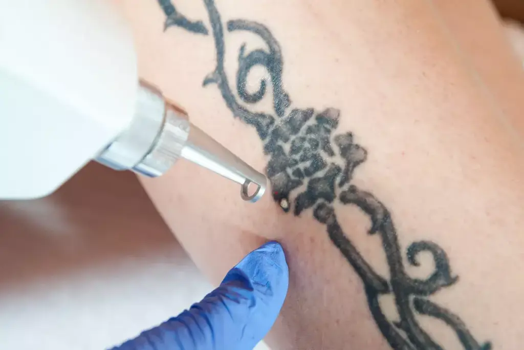 How Bad Does Tattoo Removal Really Hurt?