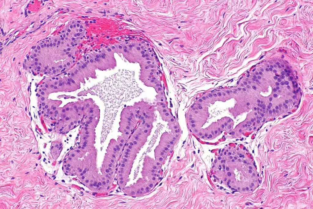 How to Excise Lesion: Managing Atypical Papillary Lesions 3 How to Excise Lesion: Managing Atypical Papillary Lesions
