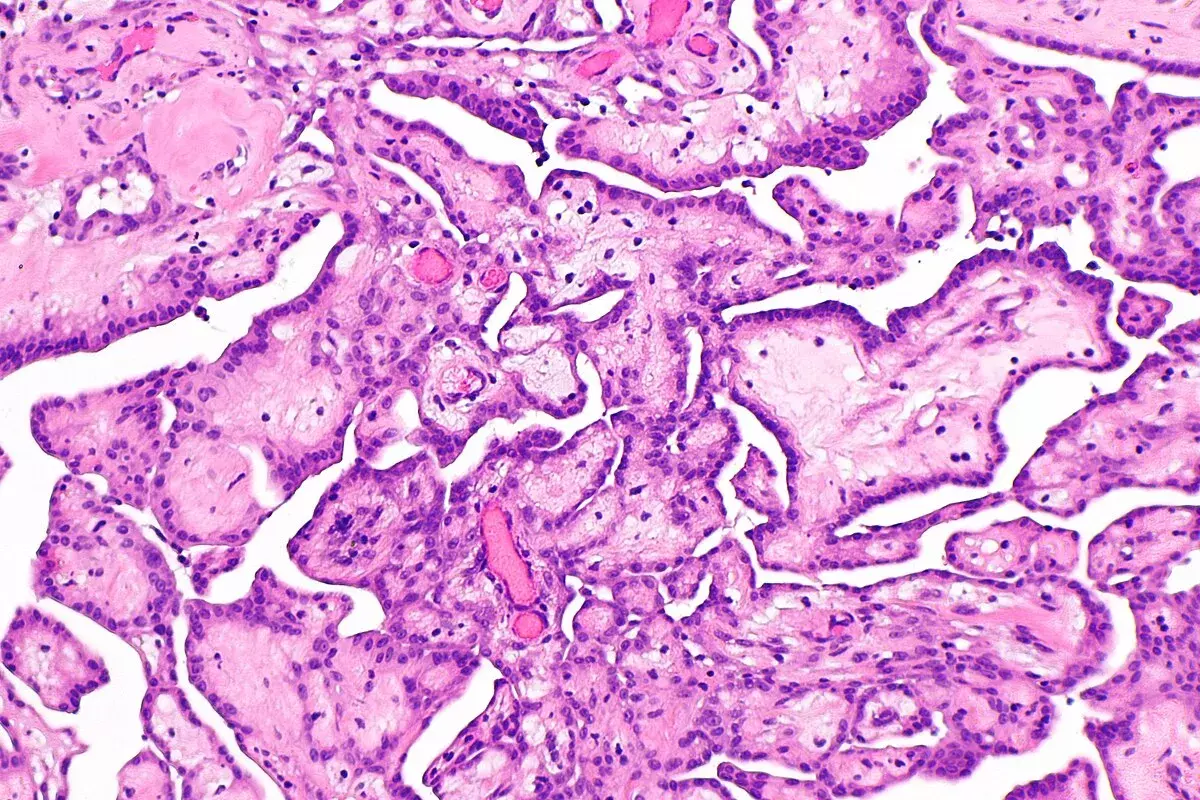 How to Excise Lesion: Managing Atypical Papillary Lesions