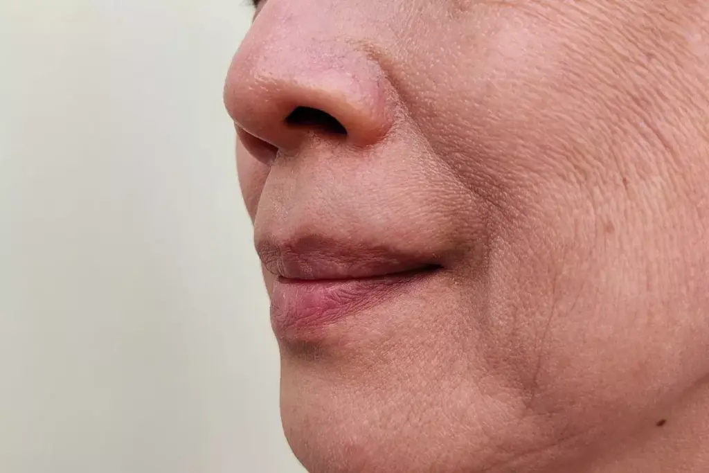How to Treat Upper Lip Scars: Complete Guide