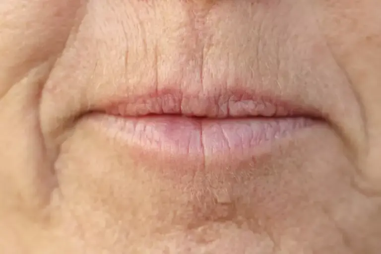 How to Treat Upper Lip Scars: Complete Guide