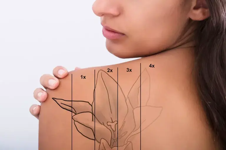 How to Remove Color Tattoos: Complete Guide