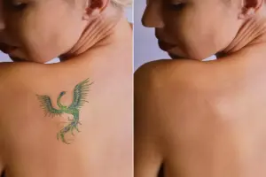 How to Erase Tattoo Naturally: 7 Proven Methods