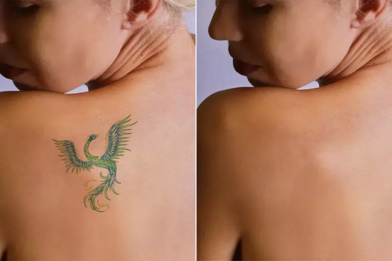 How to Erase Tattoo Naturally: 7 Proven Methods