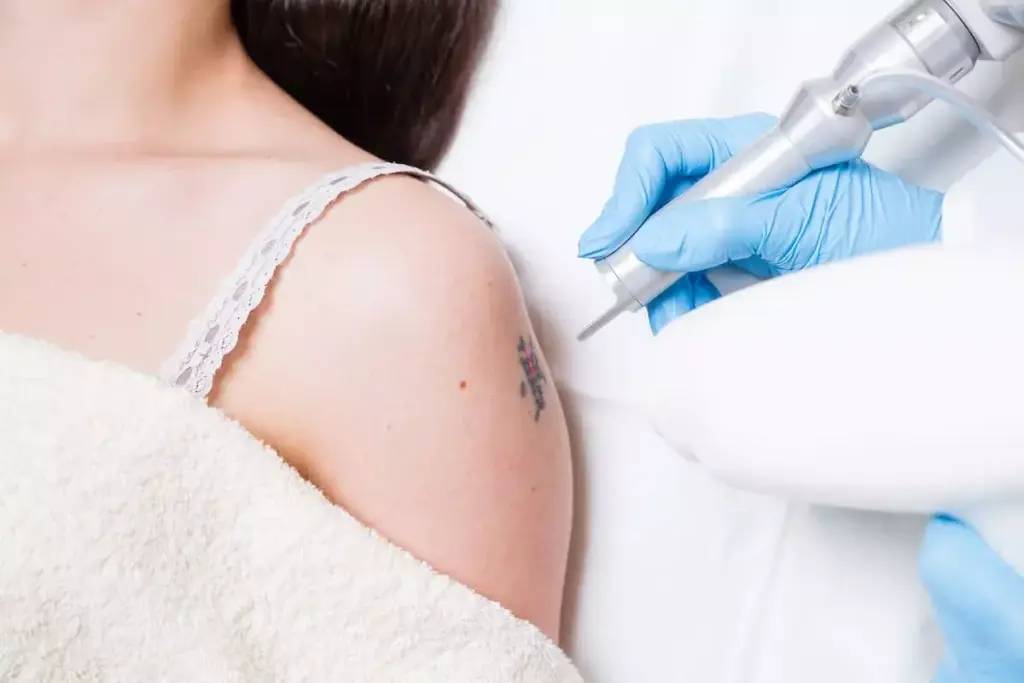 How to Remove a Tattoo: Surgical Excision vs Chemical Peel