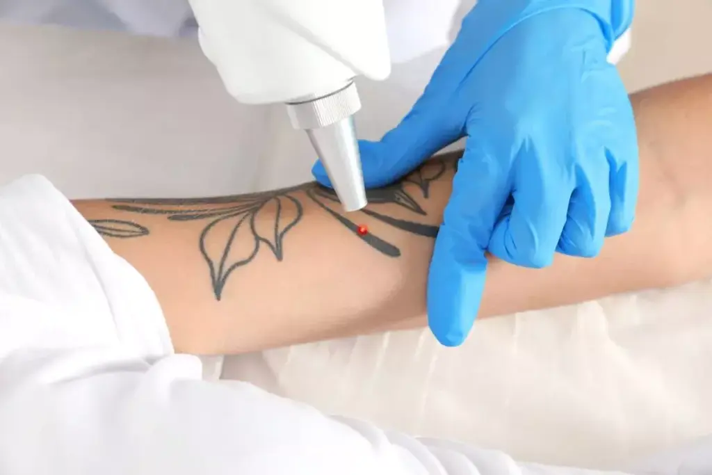 How to Remove a Tattoo: Surgical Excision vs Chemical Peel