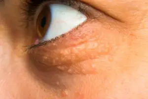 How to Remove Xanthelasma Palpebrarum: Treatment Options
