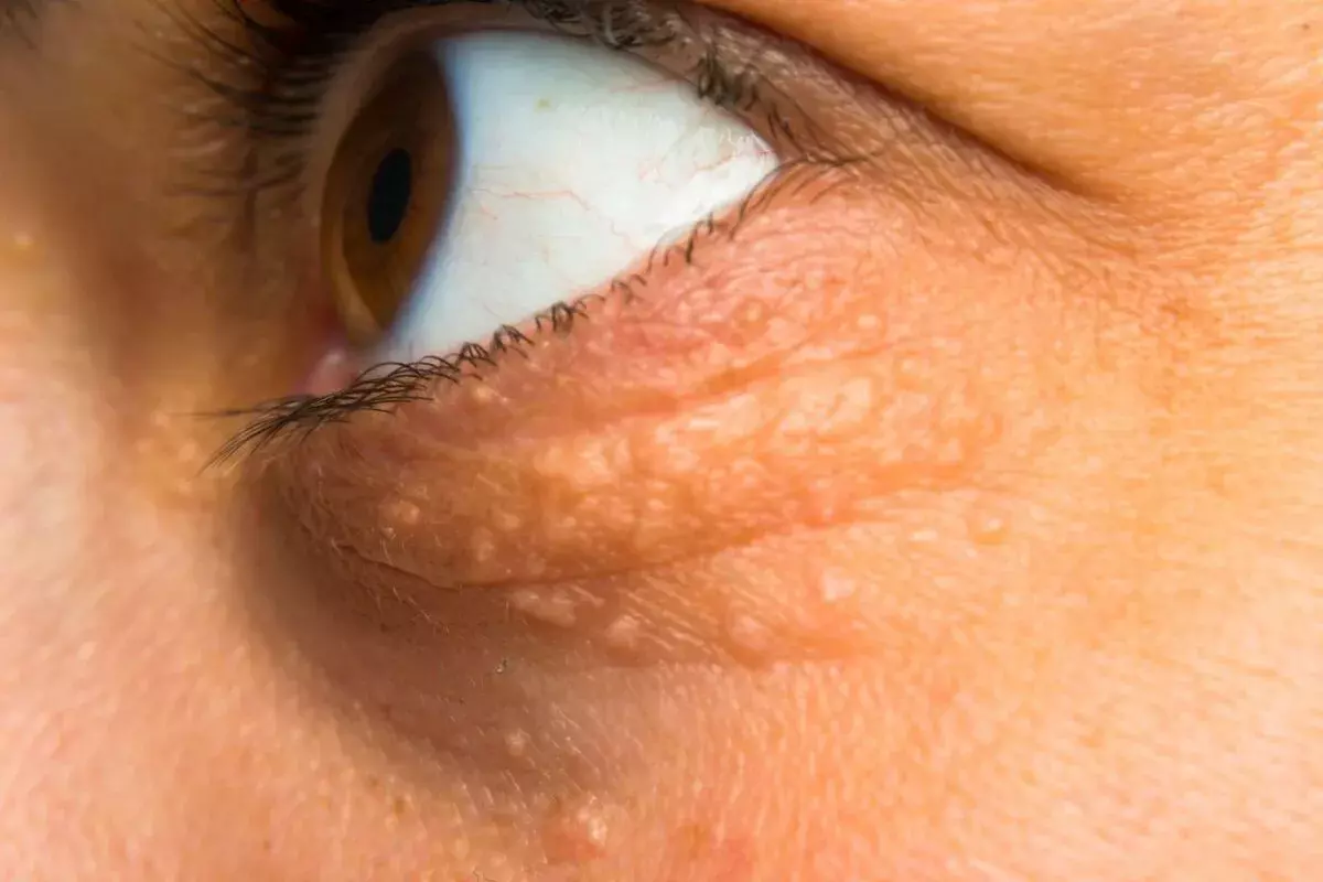 How to Remove Xanthelasma Palpebrarum: Treatment Options