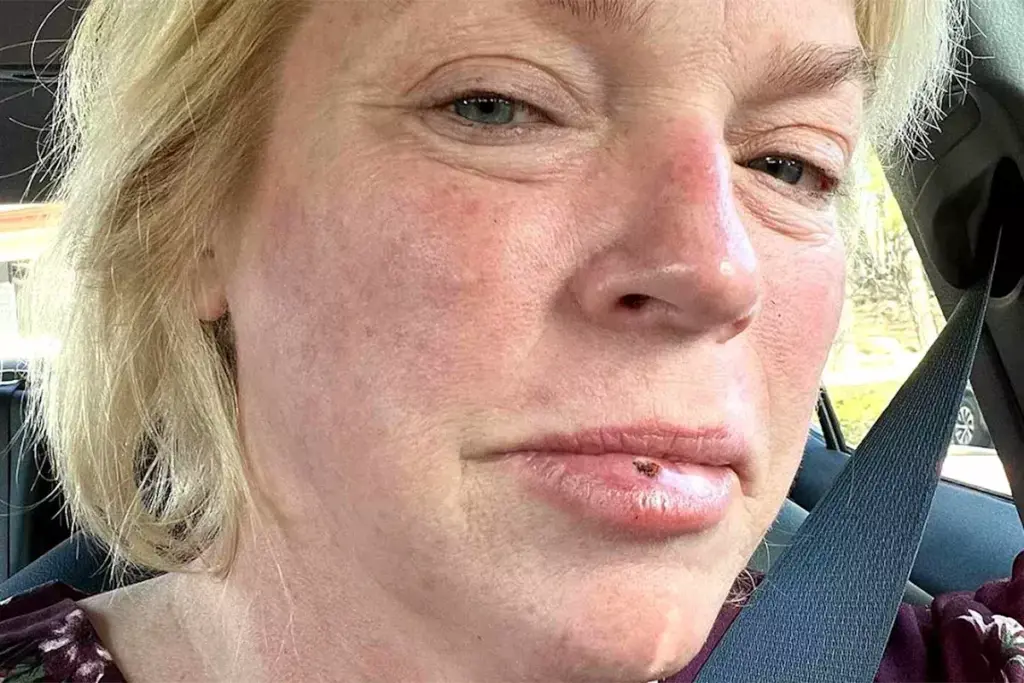 How to Manage Pain After Basal Cell Carcinoma Removal