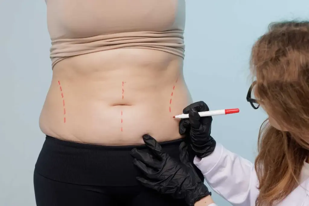 How to Get Abdominal Liposuction Results: Before and After 1 How to Get Abdominal Liposuction Results: Before and After