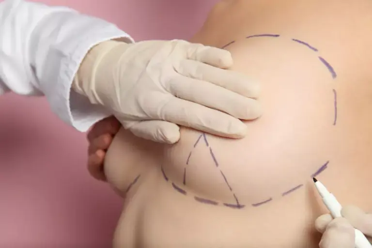 How to Minimize Breast Lift Scars: Complete Guide