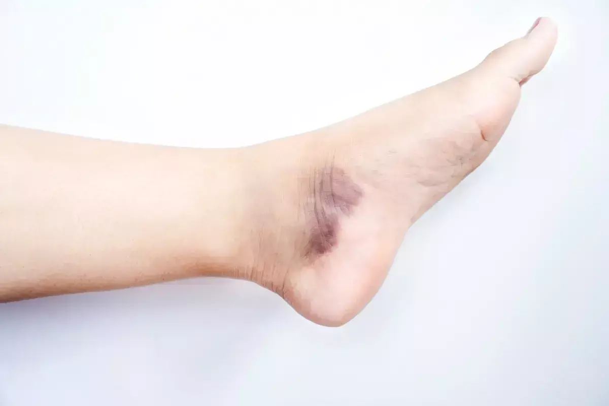 Can Cellulitis Cause Bruising and Red Streaking on Your Skin?