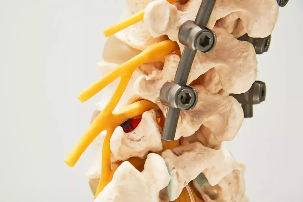 What Is a Cadaver Bone Graft and How Does It Work in Spinal Fusion?
