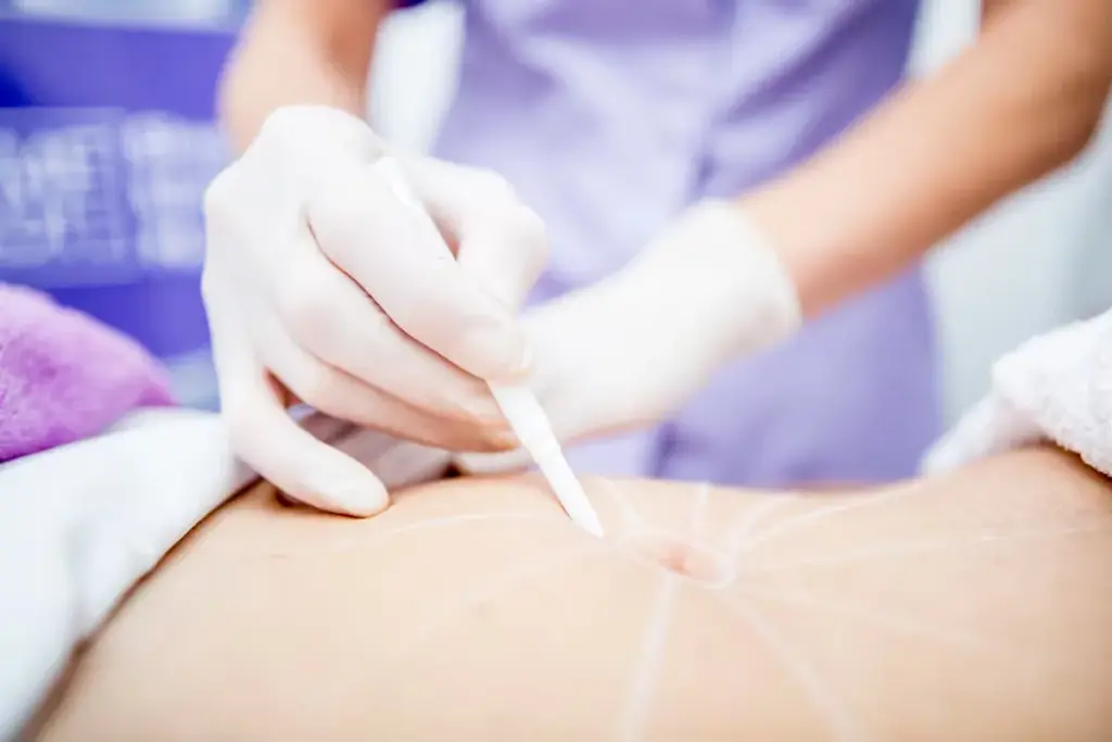 How to Minimize Belly Button Surgery Scars