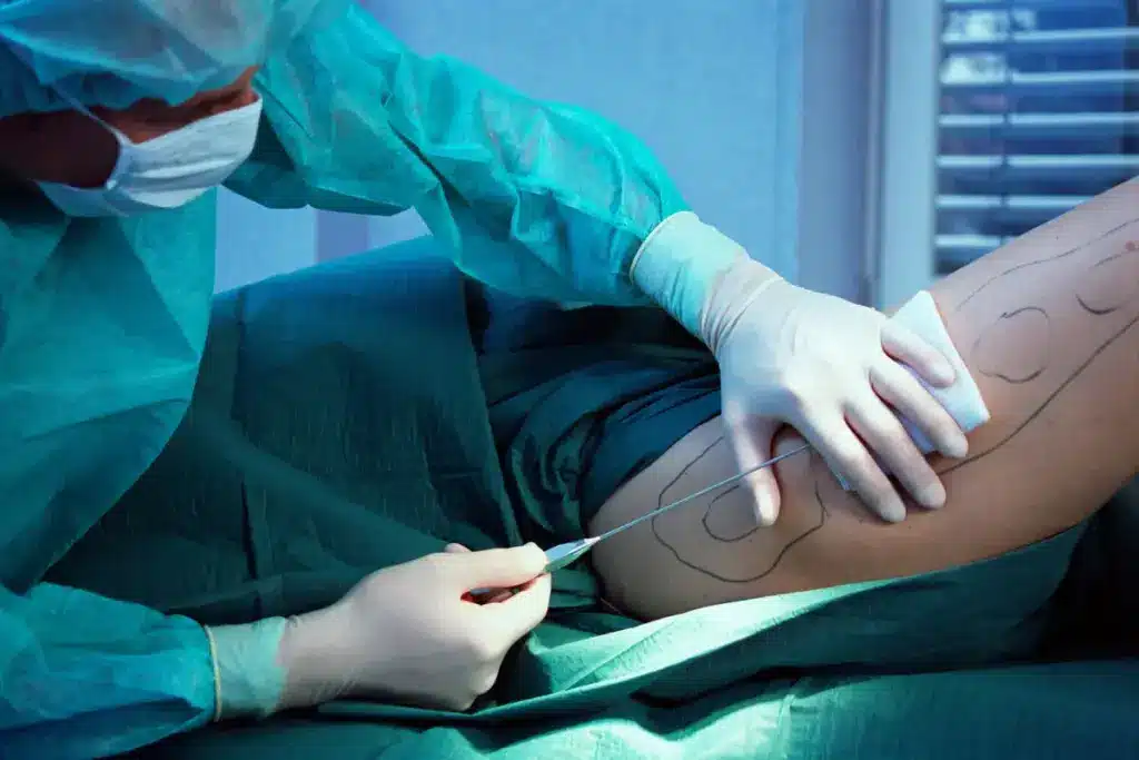 How to Recover from Thigh Lift Surgery: Complete Guide
