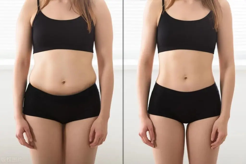 How to Get Thigh Liposuction: Before and After Results