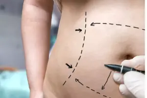 How to Prepare for Vertical Abdominoplasty: Complete Guide