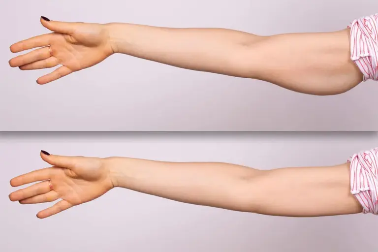 How to Minimize Arm Reduction Scars After Brachioplasty