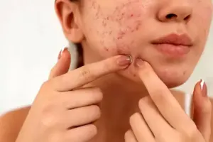 How to Get Rid of Pimple Scars: Complete Guide