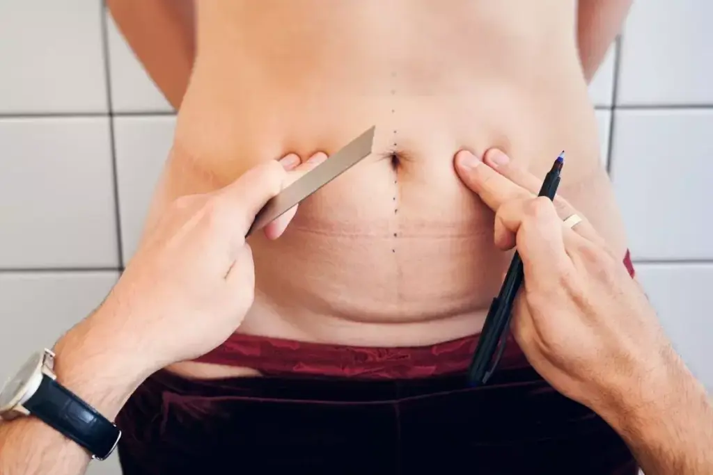 How to Manage Recovery 4 Weeks After Tummy Tuck 3 How to Manage Recovery 4 Weeks After Tummy Tuck