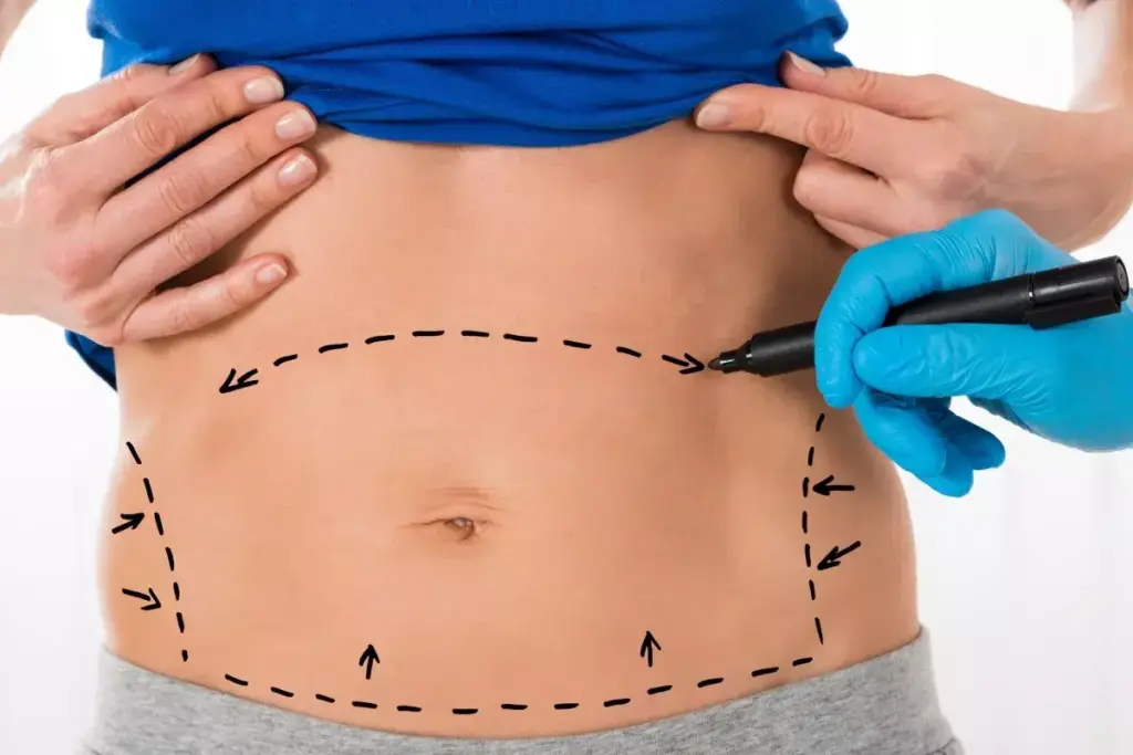 How to Prepare for Abdominal Wall Reconstruction Surgery