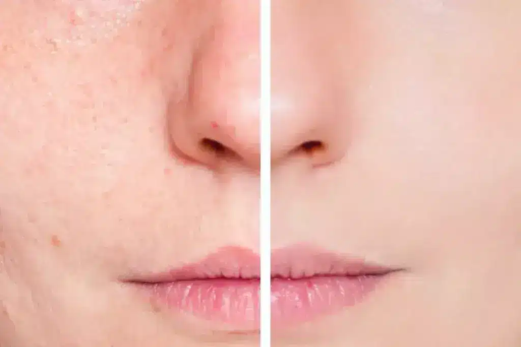 How to Recover After Skin Removal Surgery: Timeline & Tips