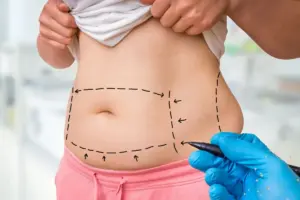 How to Fix Diastasis Recti: Before and After Results