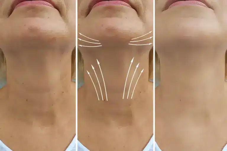 How to Get an Arm Lift: Complete Surgical Guide