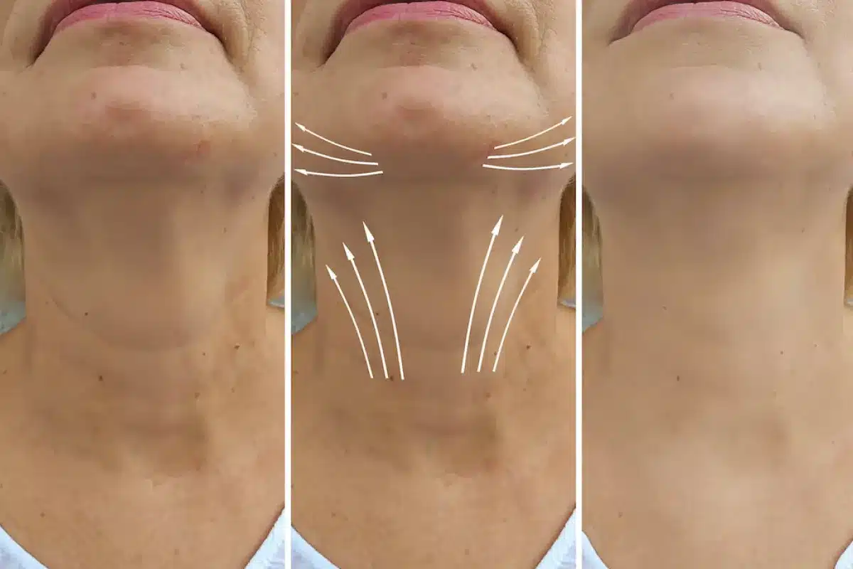 How to Get an Arm Lift: Complete Surgical Guide