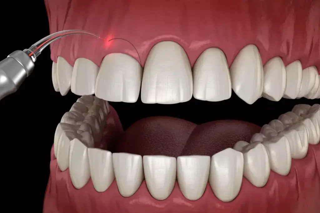 Do Gum Grafts Work? Effectiveness and Alternatives Explained