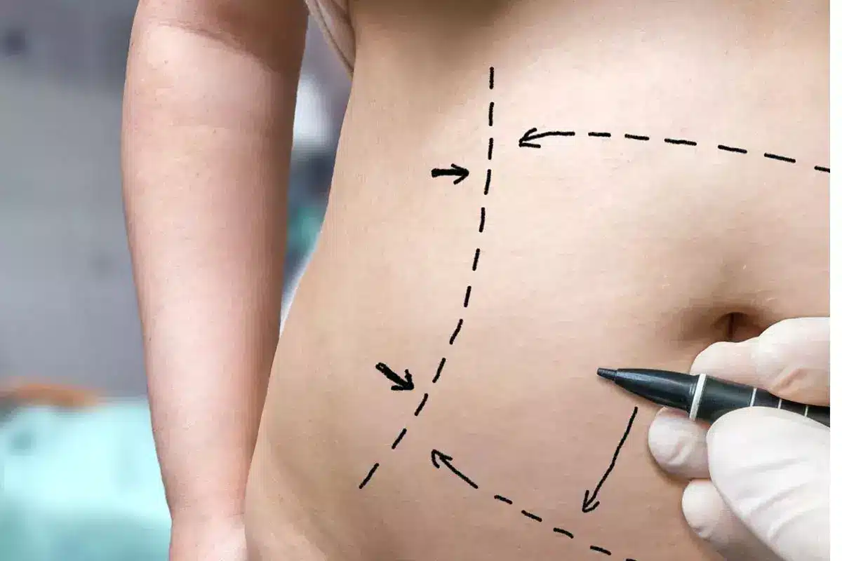 How to Heal From Plastic Surgery: Recovery Guide