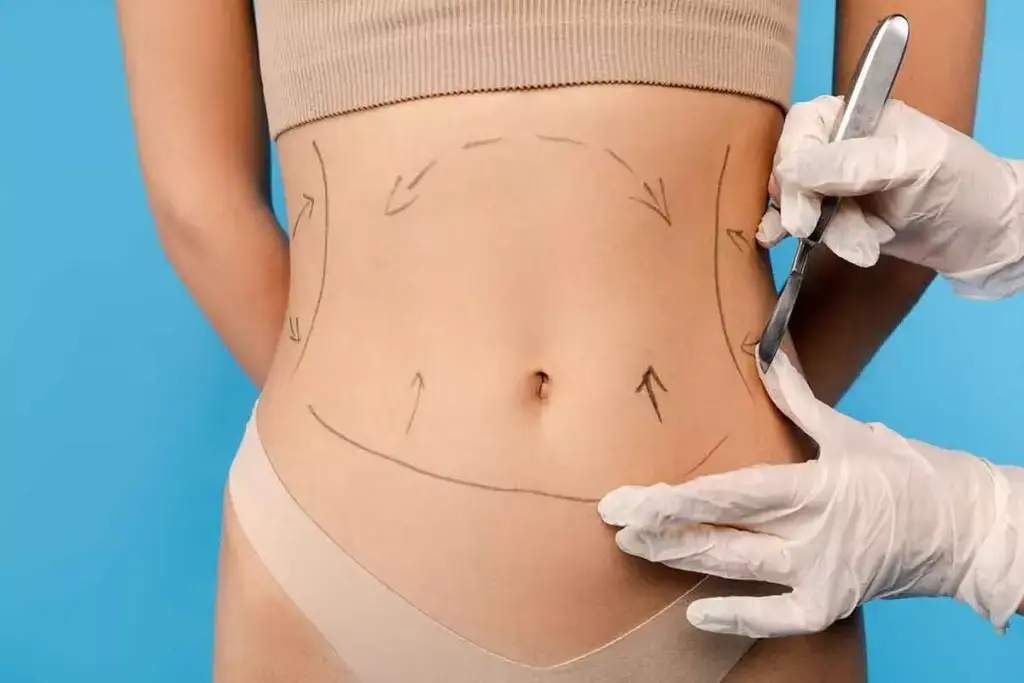 How to Recover from Mini Abdominoplasty: Week-by-Week Guide