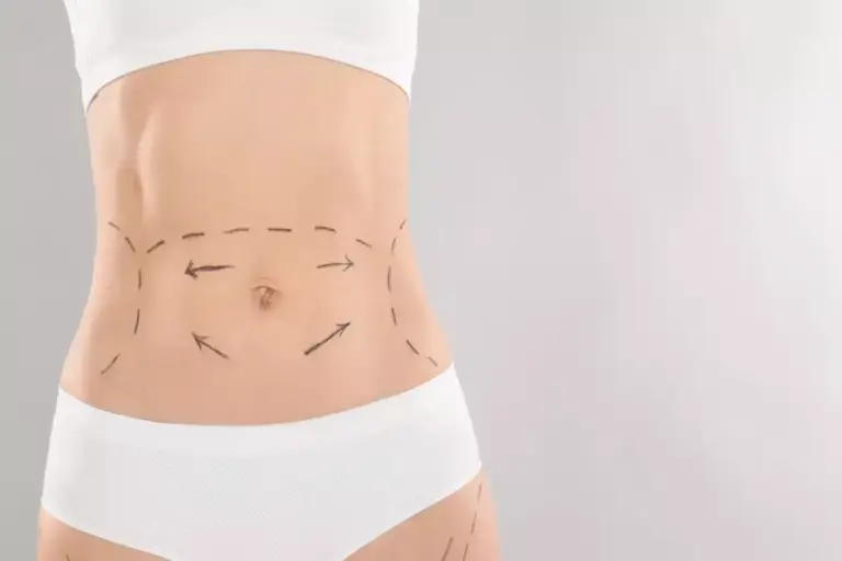How to Get Mini Abdominoplasty With Liposuction