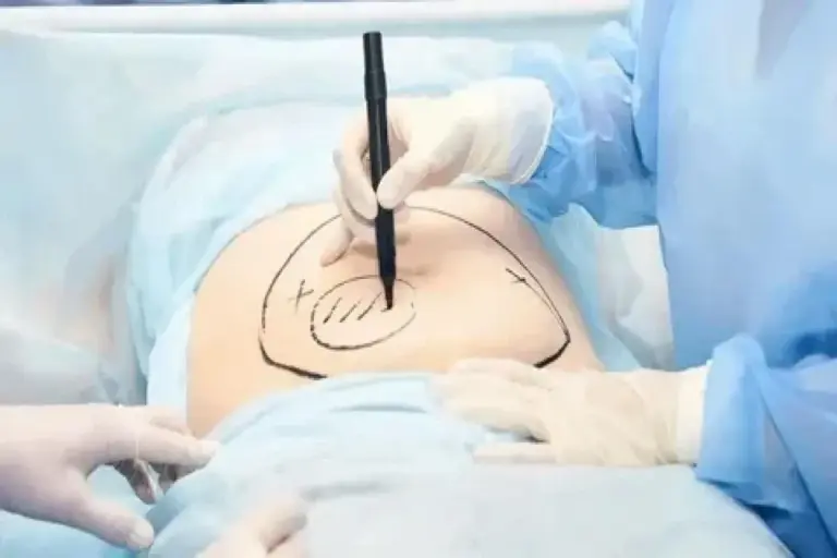 How Long Does It Take to Recover from Liposuction?