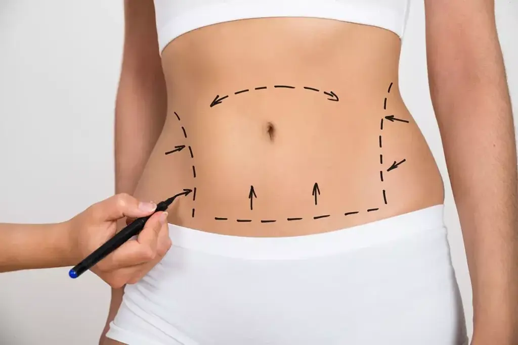 5 Best Tummy Tuck Options in Miami: Affordable Lipo Procedures