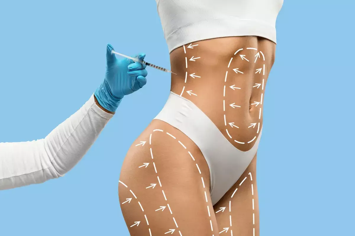 5 Best Liposuction Alternatives: Non-Invasive Options for Belly Fat