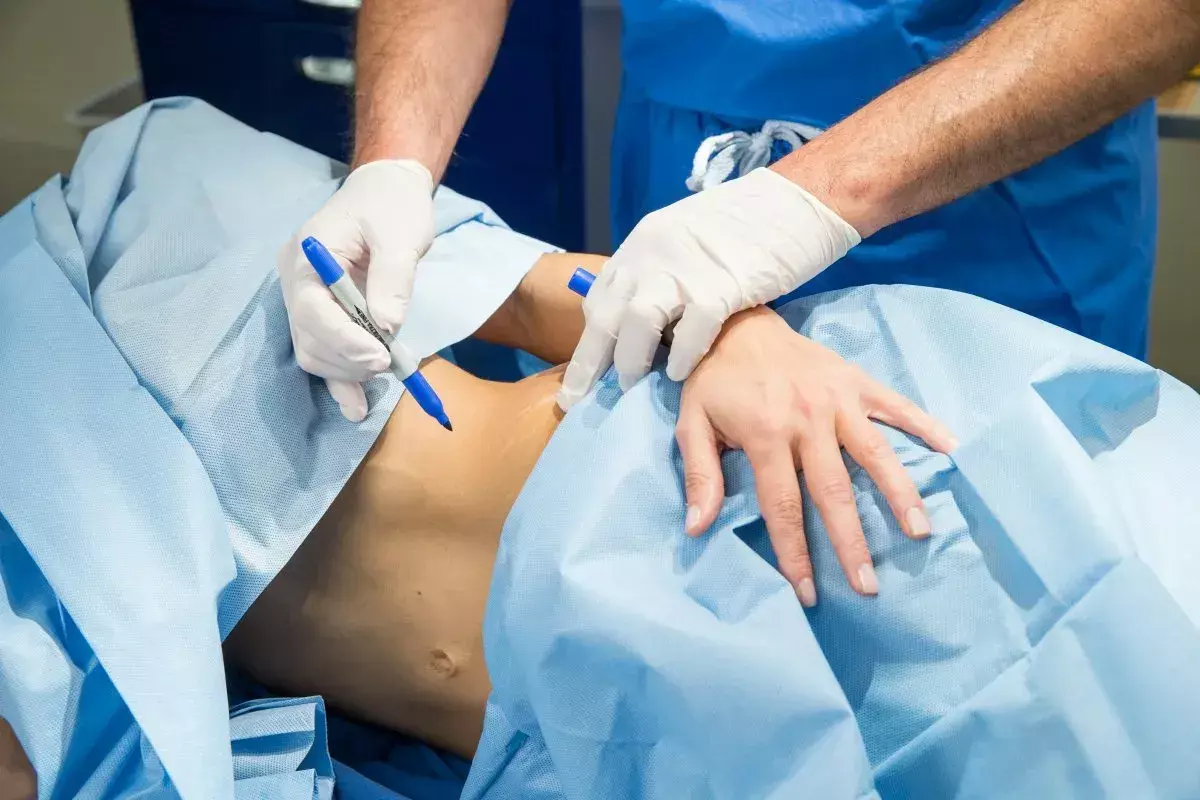 Can You Get Liposuction If You're Overweight or Obese?